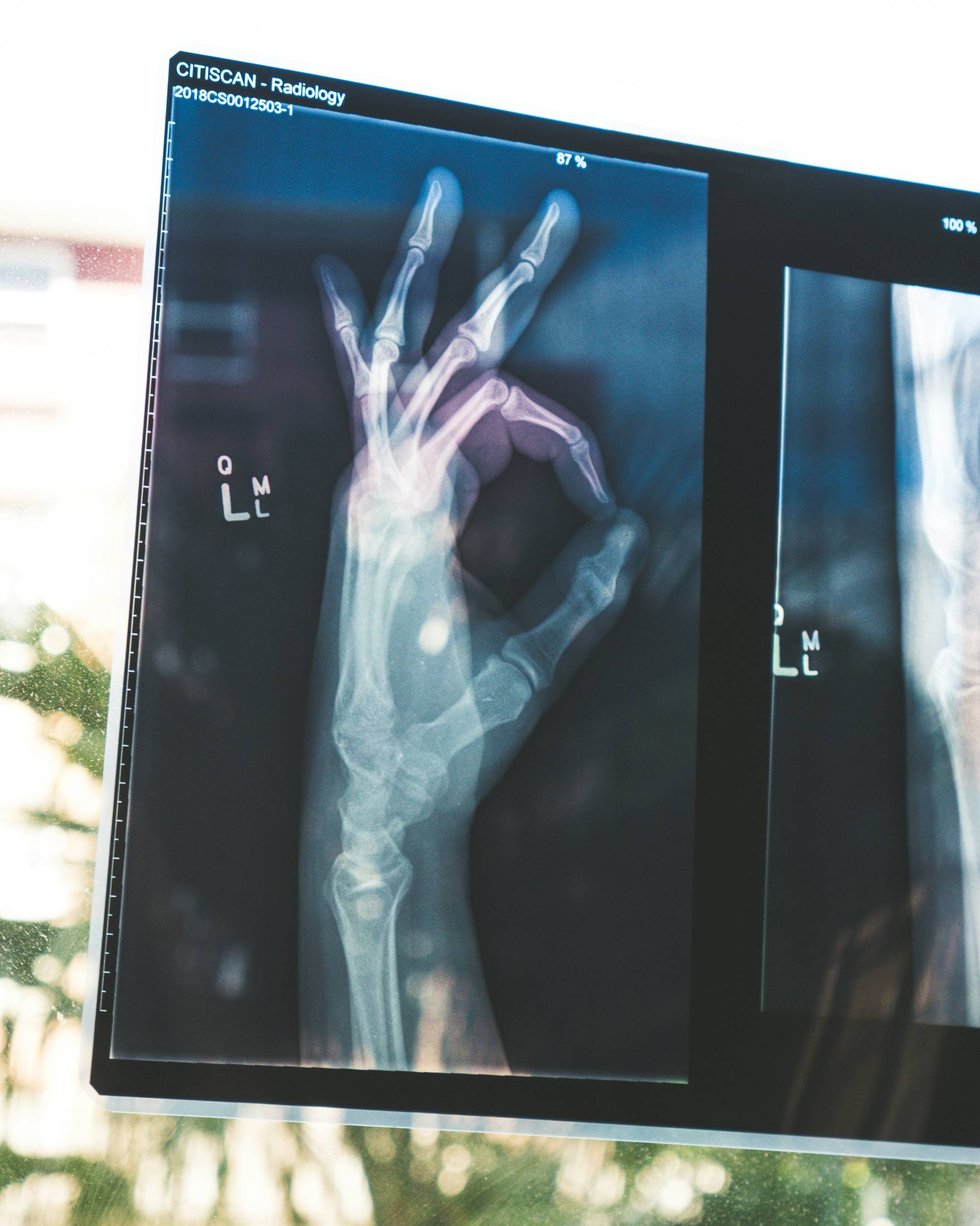X-ray of a left hand giving the "OK" symbol